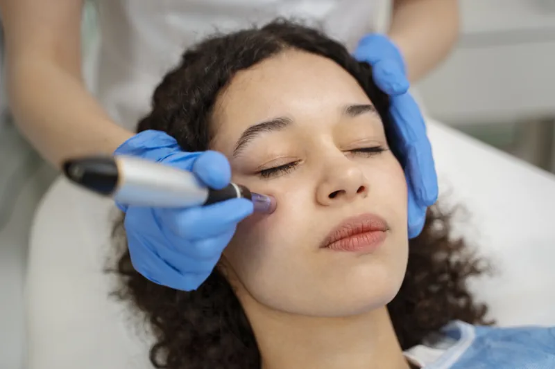 Professionelles Micro-Needling in Aachen und Alsdorf