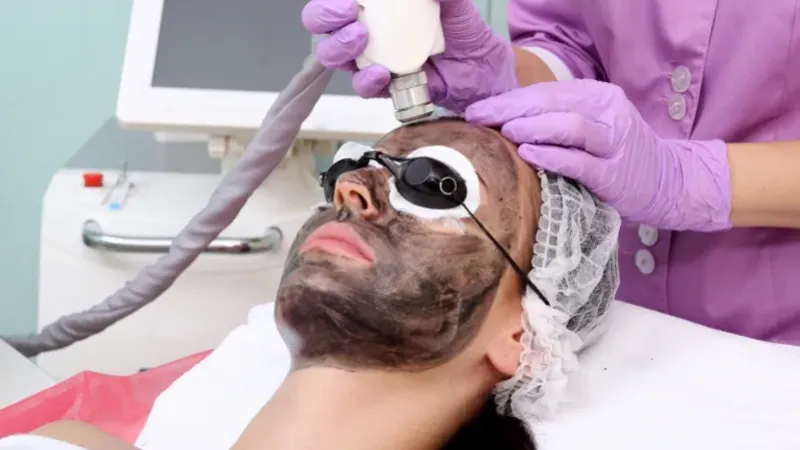 Hollywood Carbon-Peeling